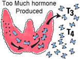 Thyroid gland: an illustration of too much thyroid hormone being produced, or hyperthyroidism